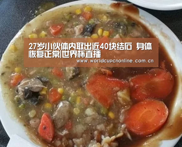 27岁小伙体内取出近40块结石 身体恢复正常|世界杯直播(图2) 世界杯直播